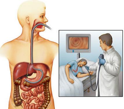 胃肠镜检查——约还是不约?这是个值得思考的问题!
