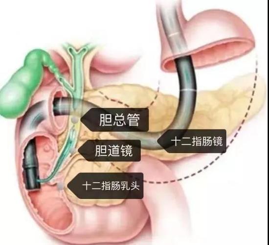 消化内科成功开展首例经口胆道镜诊疗技术