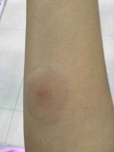 你好,我两天前做了结核皮试,现在手上没有硬结,但是有