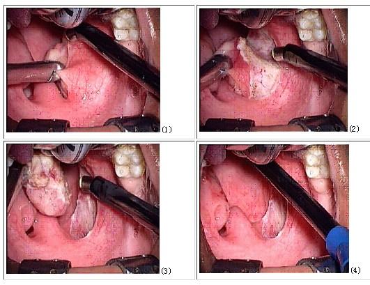 慢性萎缩性咽炎咽黏膜增厚明显,腭垂肿大,下垂,咽侧索呈条束状肥厚