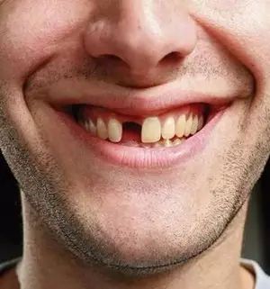 估计现代科技也拯救不了你, 这万一缺了门牙更是糟糕, 你都不敢出门