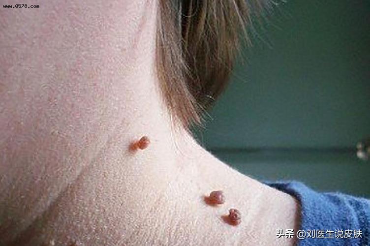 据观察,大多数咨询的患者,身上长的肉疙瘩都不痛不痒,若不影响美观