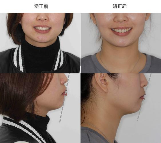 矫正改变脸型!方脸女生的不拔牙矫正