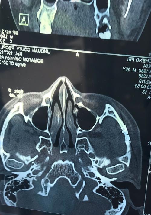 颧骨平扫ct示:颧弓复位可,连续性良好,钛板固定密合,钛钉无脱位.