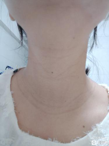 孕晚期发现脖子上的颈纹很严重