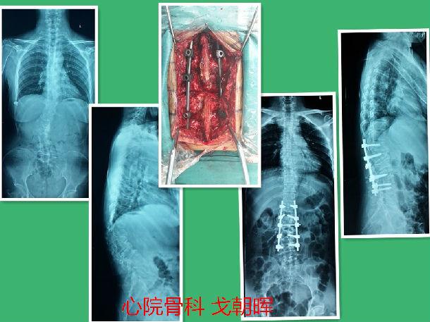 成人腰椎陈旧性骨折并退变性侧凸-srs4级截骨,矫形满意