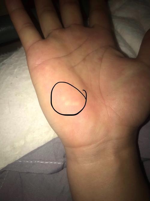 万能的网友们,我手掌上长出了白色的硬块,特别是手掌摊开后特别明显