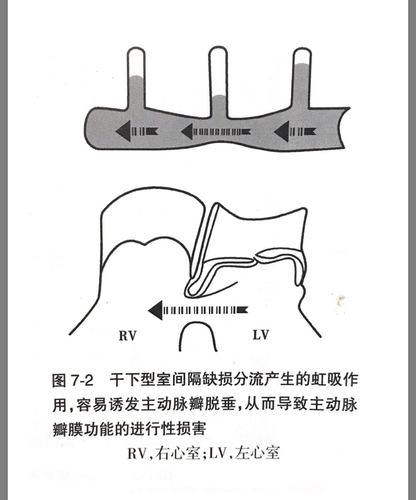 为什么主动脉瓣脱垂的嵴内型室间隔缺损或是嵴上型室间隔缺损或是干下