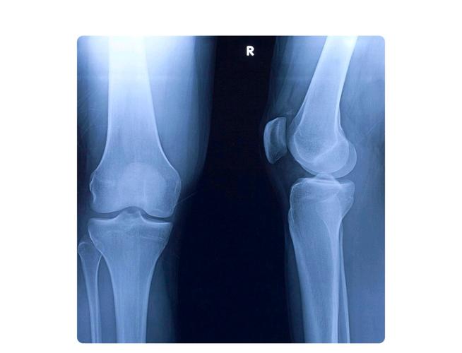 正常膝关节x线图