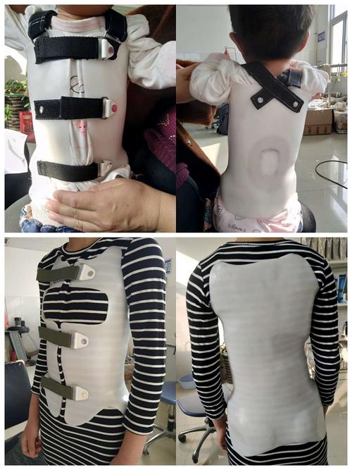 脊柱侧弯矫形支具
