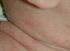 婴儿湿疹症状图片