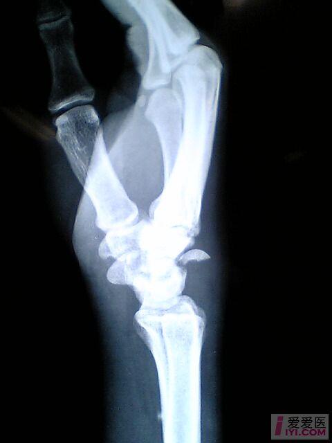 讨论少见的骨折手腕头状骨骨折