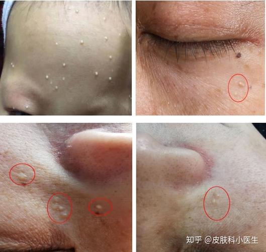 粟丘疹案例分享