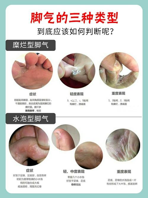 气78脚臭78糜烂78水泡78