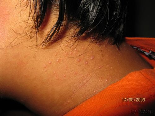 楼主上挺2009-08-15 22:57:03   某男,28岁,颈部出皮疹2月余,时有微