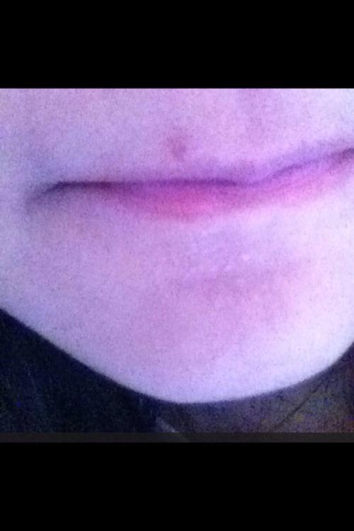 我的嘴唇上长了一个黑头,该怎么办!好多天了好丑.