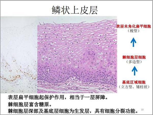 正常食管上皮由没有角化的复层鳞状上皮组成,什么叫角化呢?