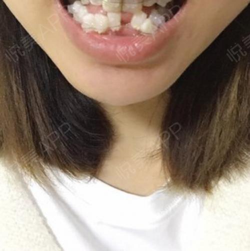 牙齿矫正手术当天_牙齿美容手术当天_vip‖部落分享图片3