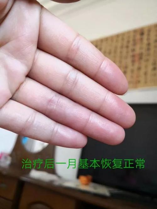 妈妈拎了20斤菜,居然勒出血管瘤!医生说:这几类人要