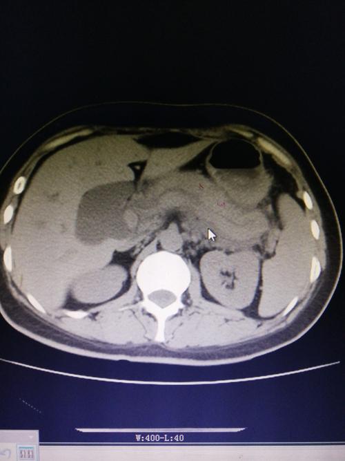 普外二科之 —— 急性胰腺炎