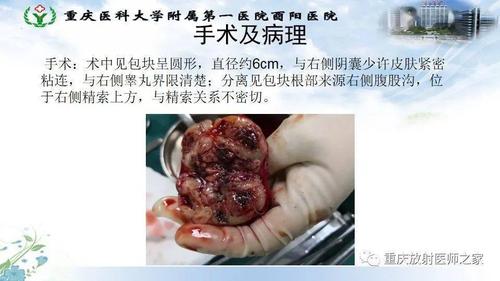 每日一例118178岁男发现阴囊包块2年多