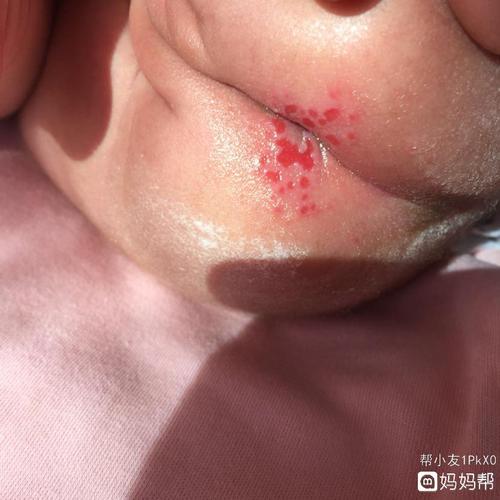 宝宝屁股腋窝大腿根淹红渥烂破皮红肿的对治方法.宝妈