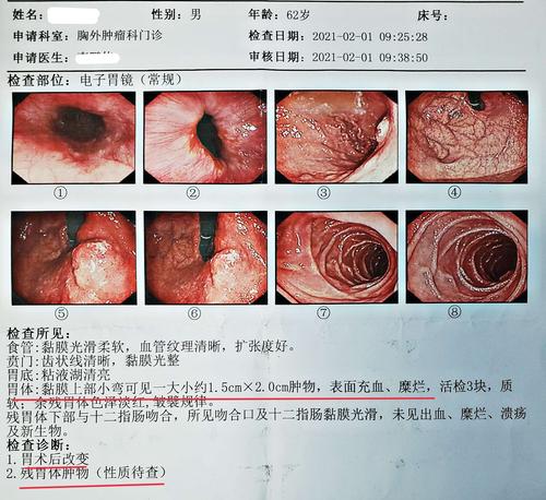 胃镜检查显示:病变位于贲门下方,胃小弯侧,大小约2.0cm.
