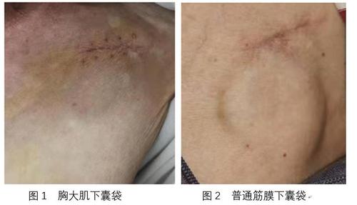 埋入心脏起搏器,解除了患者近10年的"心病"