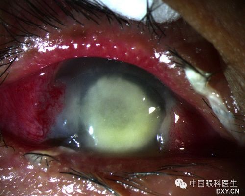 胬肉手术高手告诉你怎样才是成功的翼状胬肉手术