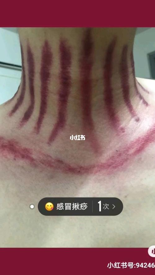 揪痧_周末_我的第一篇笔记_医疗健康_医疗方法