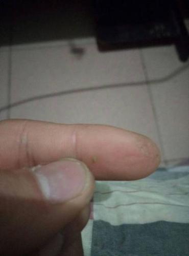 我的阴茎冠状沟那里有个小疙瘩,但是可以挤出来有个小颗粒 奶白色的