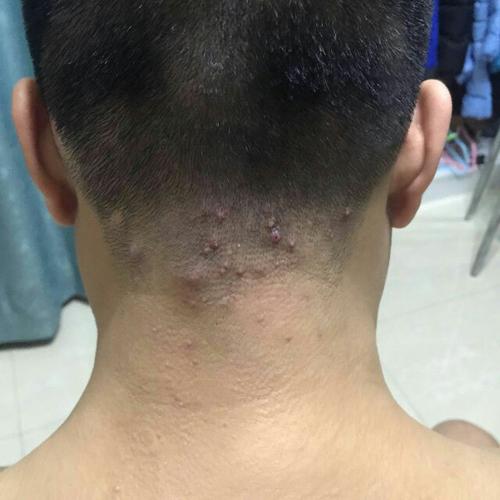 我的头后面长了很多包,请问大家谁知道是什么病,万分感谢,我附上了一