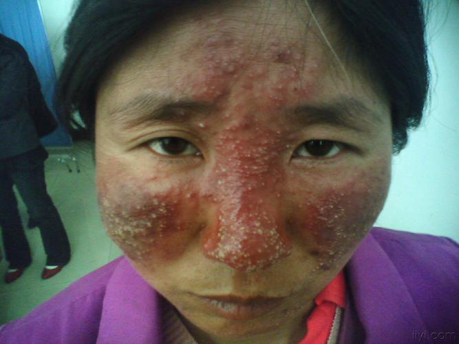 治疗前后的颜面部皮肤病(附图)