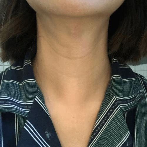 哈医大四院专家带您了解腔镜甲状腺微创手术