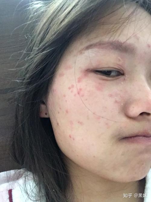 扁平疣痊愈啦谈谈我七年的心酸经历