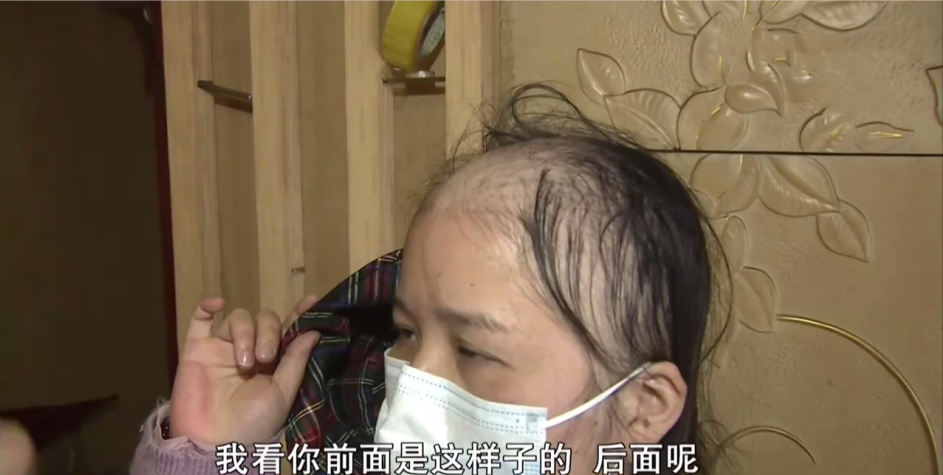 我头发呢?女子做完养发后秀发掉光变成了"裘千尺"!