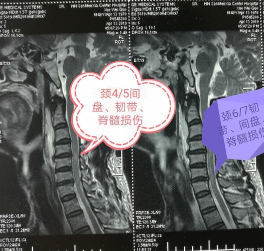 术前颈椎核磁共振检查显示颈脊髓于4/5,6/7平面损伤