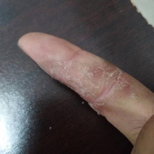 手指皮肤变硬脱皮!各位老大看我看看这是什么回事!谢谢!