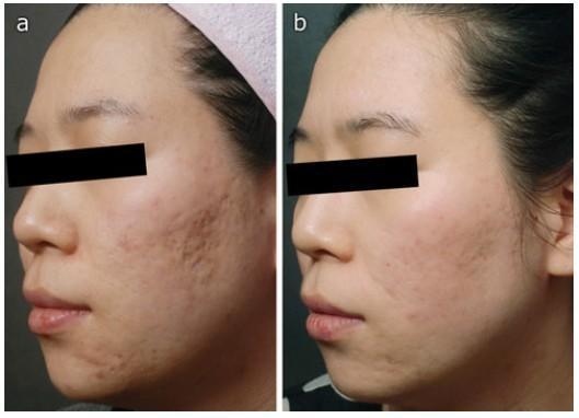 生活中有一些小方法可以减轻或预防痘痘疤痕,要想达到理想的祛痘疤