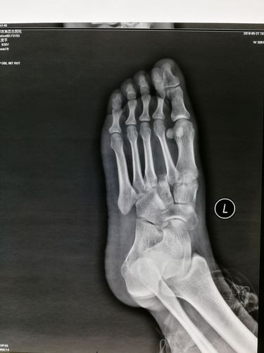 患者,女,39岁,从一米高处摔下,诊断,左足lisfranc损伤,请教入路,固定
