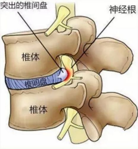 腰椎间盘突出,今天带大家一起去详解一下