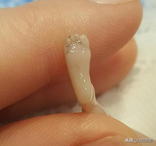 母亲分享流产14周的胎儿照片,胎儿10厘米已成型,劝大家不要堕胎