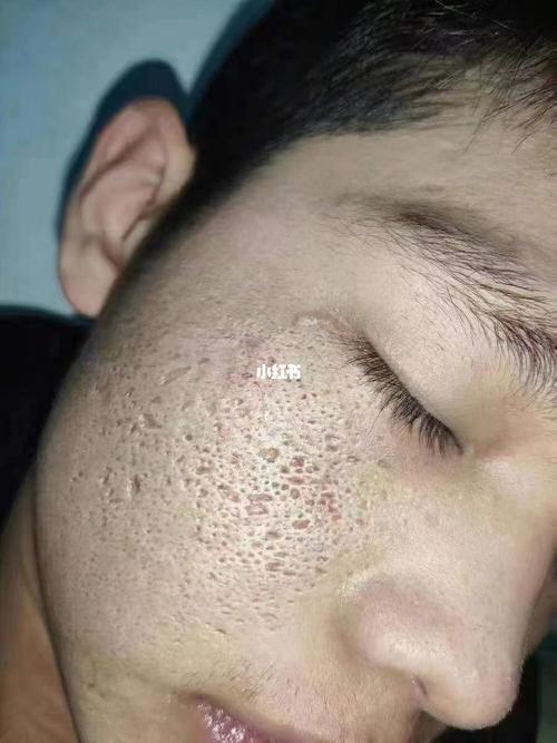 凹陷疤痕属于组织缺失_疤痕_痘坑_美妆_护肤