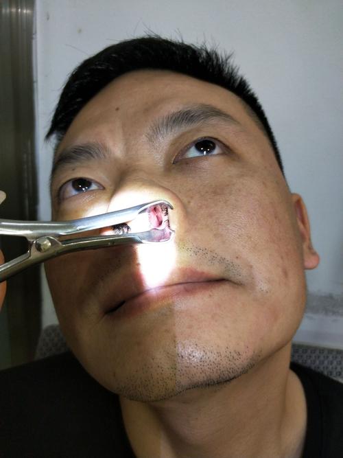 2018年4月1号,湖北籍张先生左边鼻腔呈全封闭状态,无法呼吸的同时眼角