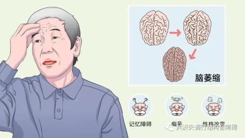 小脑萎缩一旦达到晚期会发生许多的症状表现