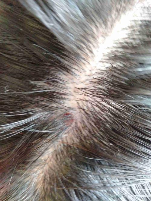 头发很痒,头皮出血了,我挠的.可以用皮炎平吗?