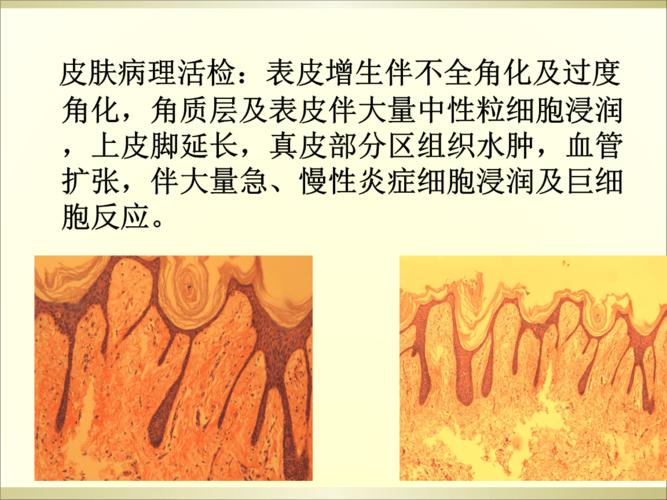 化脓性汗腺炎二例.ppt 30页