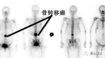 骨转移瘤的影像学检查主要包括x线,ct,mri检查及全身骨扫描.
