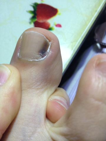 已经2星期了,在右脚大拇指的最右边,是内部发黑不是指甲变黑