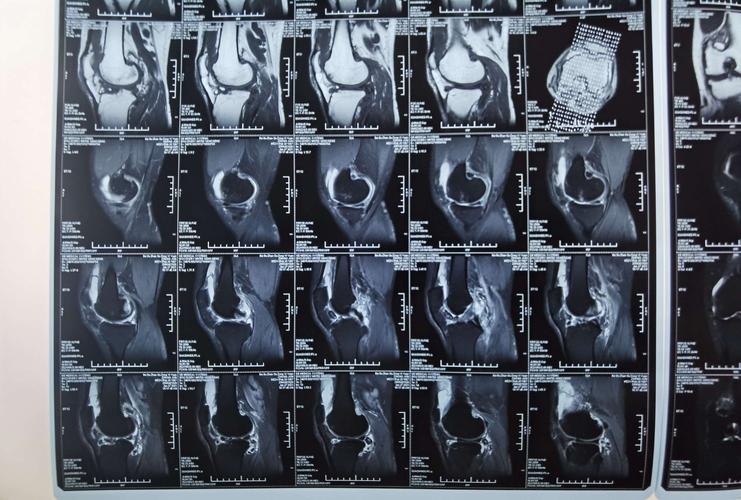 本来考虑半月板桶柄样损伤,但是核磁共振结果有点儿出乎意料,除了关节